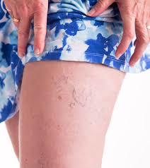 Old white people the only ones they get veins in your legs that you can see?