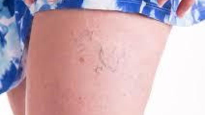 Old white people the only ones they get veins in your legs that you can see?