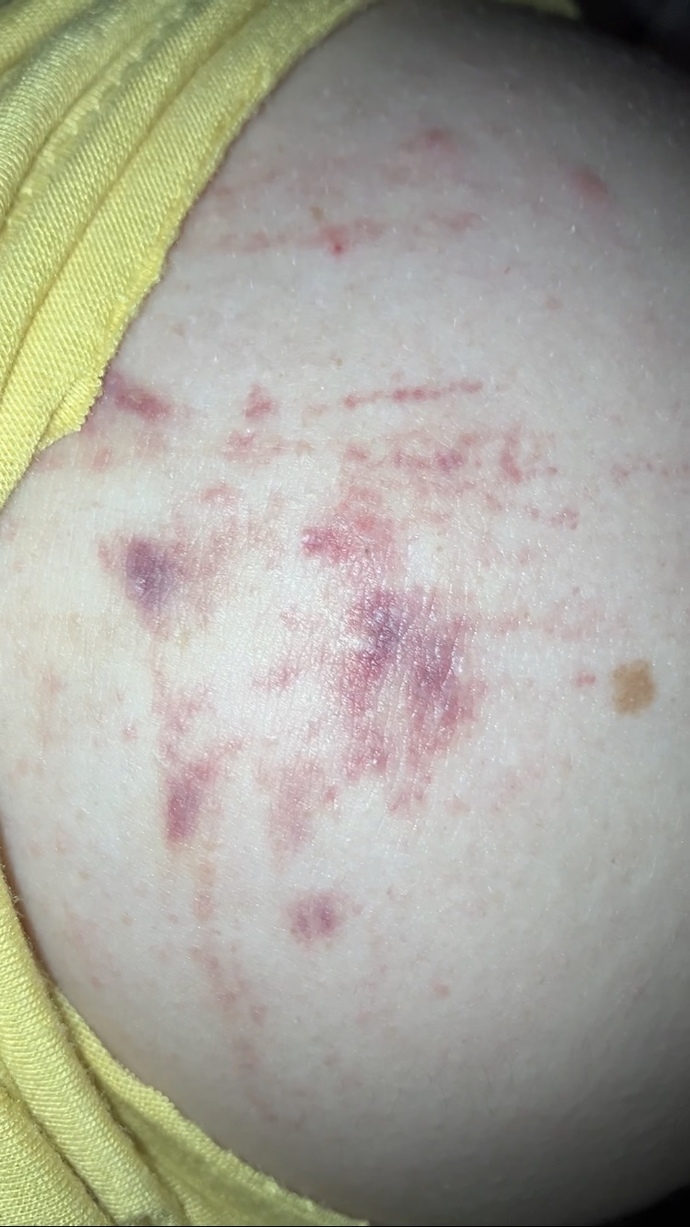 On my shoulders, are these stretch marks?