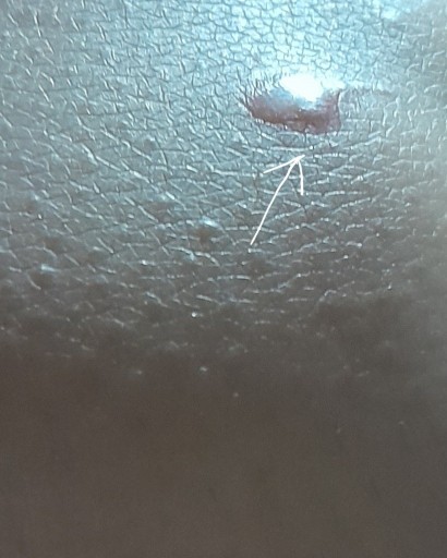 How can I get rid of the scar on my knee?