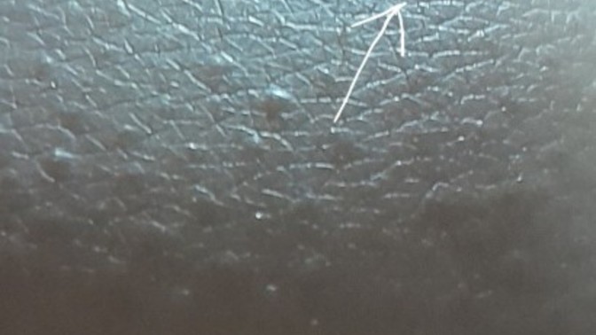 How can I get rid of the scar on my knee?