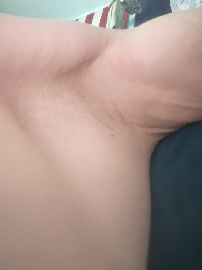 Is it possible for men to have naturally hairless armpits?