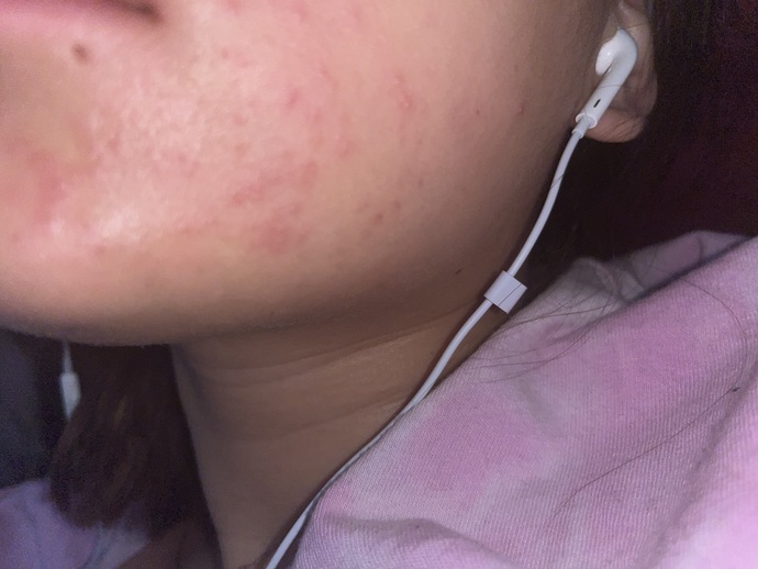 Why did I get random hives on the side of my cheek ( pic ) ?