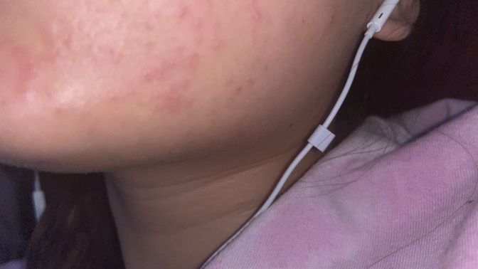 Why did I get random hives on the side of my cheek ( pic ) ?