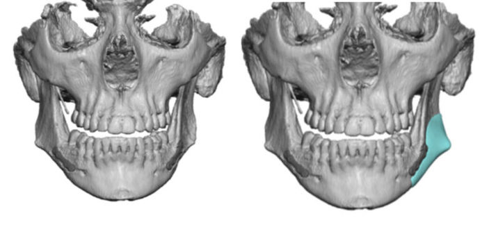 Have you ever had jaw surgery?