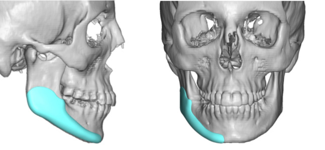 Have you ever had jaw surgery?