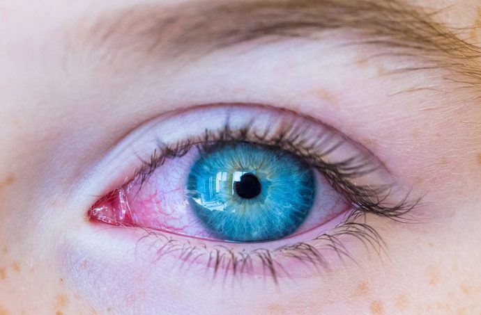 Why does shampoo burn your eyes & is it dangerous to get shampoo in your eyes?