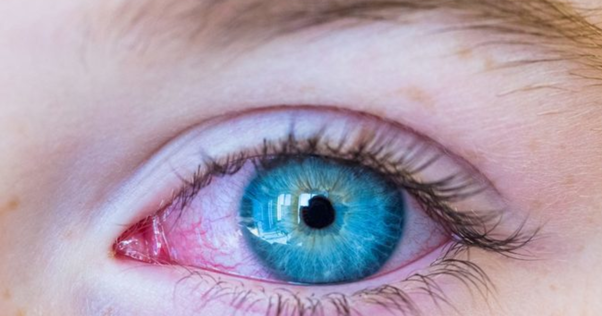 Why does shampoo burn your eyes & is it dangerous to get shampoo in