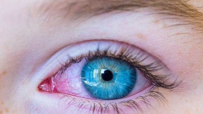 Why does shampoo burn your eyes & is it dangerous to get shampoo in your eyes?