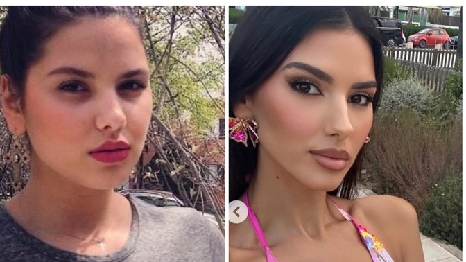 Did everyone else know that the model Jehona Dreshaj has had lots of plastic surgery, and heavily facetunes/photoshops her photos and videos?