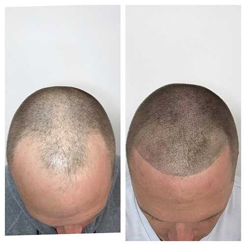That can give you a soldier-cut look.