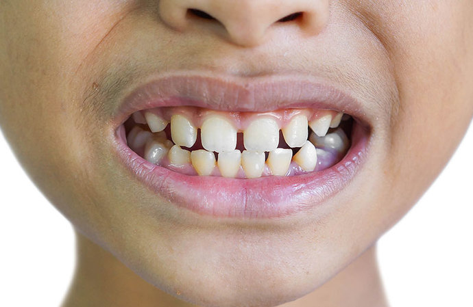 Girls, How much of a deal breaker are teeth like this on a man you are interested in?