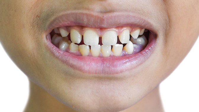 Girls, How much of a deal breaker are teeth like this on a man you are interested in?