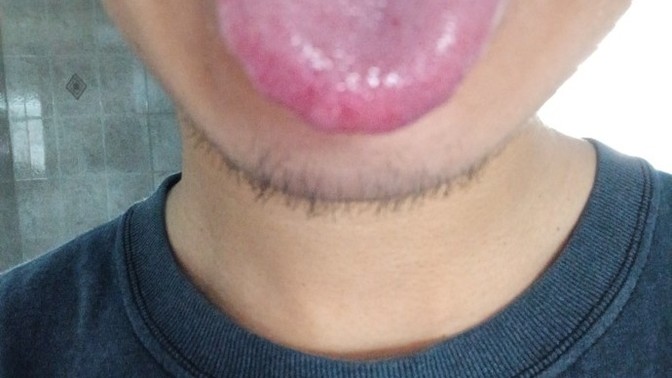 What's that black mole on my tongue?