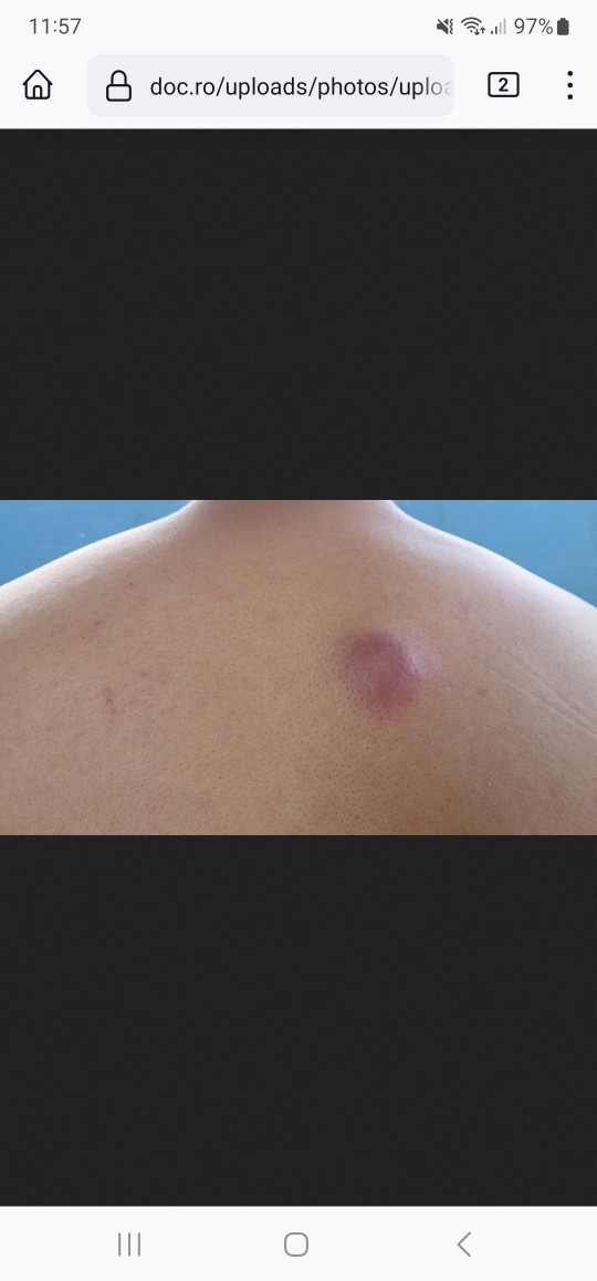So a couple days ago I noticed a lump on my scrotum which came fast does anyone else get that is it serious?