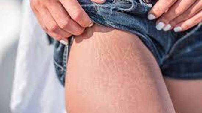 Do guys care about stretch marks?