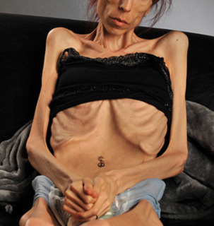 THIS is "super skinny". NOT attractive!