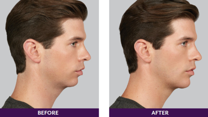 Would you date a person who gets facial fillers?