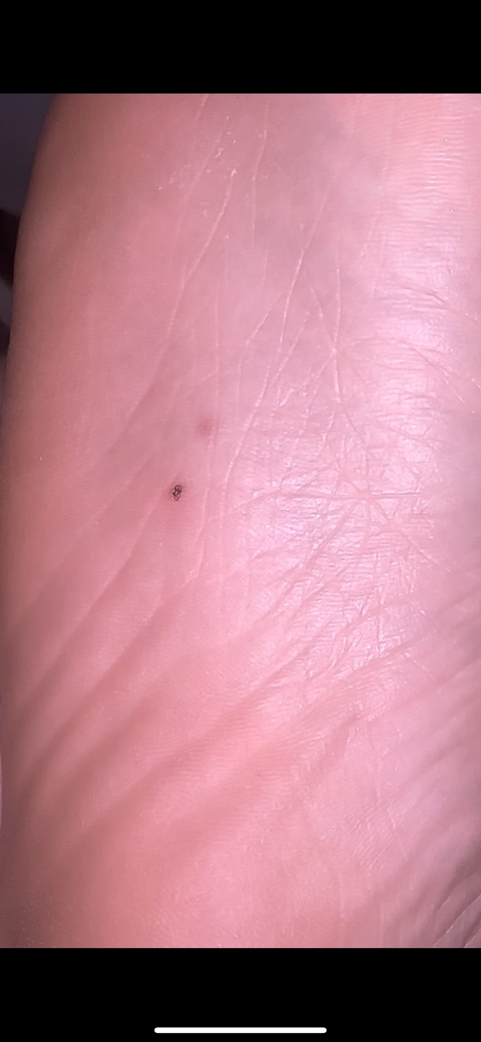 I have this random freckle under my feet,?