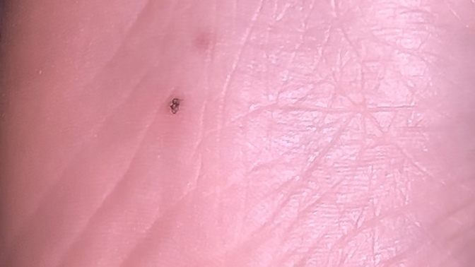 I have this random freckle under my feet,?