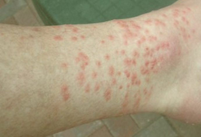 What’s the best treatment for chigger bites?
