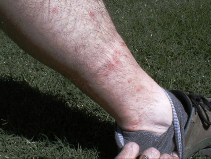 What’s the best treatment for chigger bites?