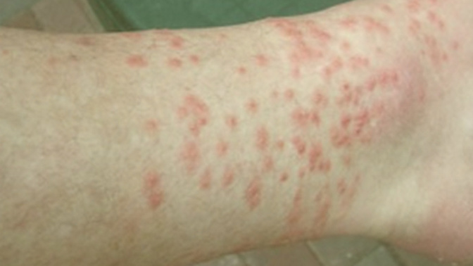 What’s the best treatment for chigger bites?