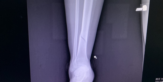 Do I need a surgery?