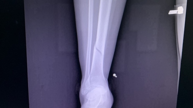 Do I need a surgery?