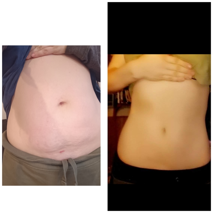 The left Pic is my stomach after my third baby right is after my second baby, are there non surgical procedures to improve my stomach?