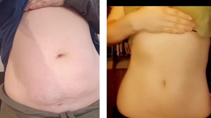 The left Pic is my stomach after my third baby right is after my second baby, are there non surgical procedures to improve my stomach?