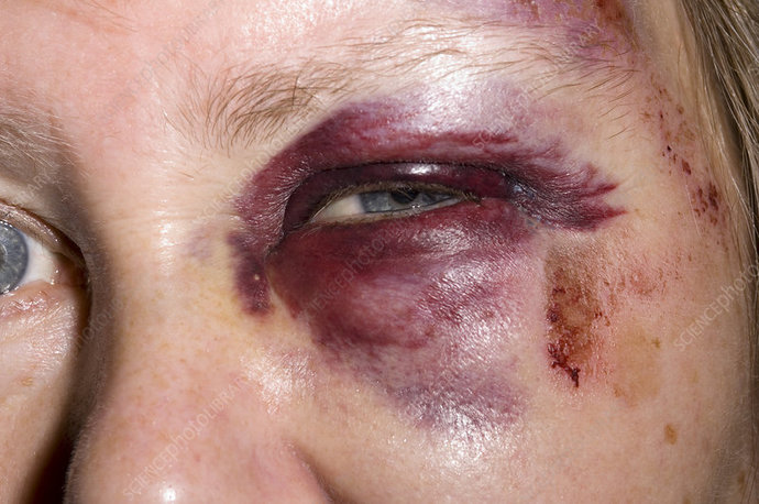 Guys, has your girlfriend/wife ever been injured on their own and people thought you did it?