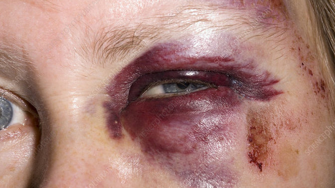 Guys, has your girlfriend/wife ever been injured on their own and people thought you did it?