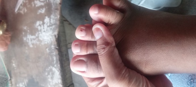 My nephew hit my nail with a chair and now it has blood? What should I do to get rid of it?