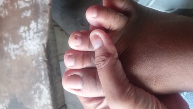 My nephew hit my nail with a chair and now it has blood? What should I do to get rid of it?