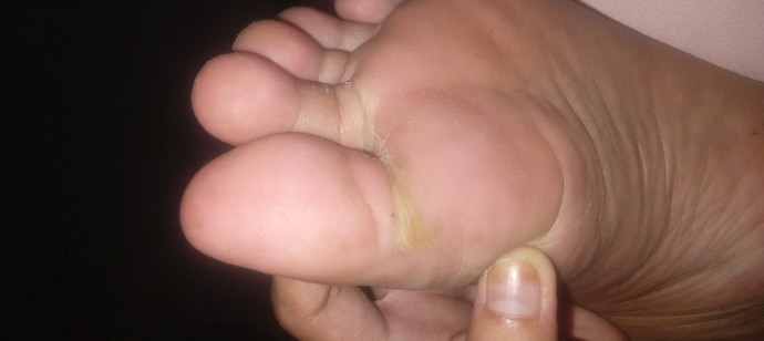 I have blister on my foot what should I do to get rid of it?