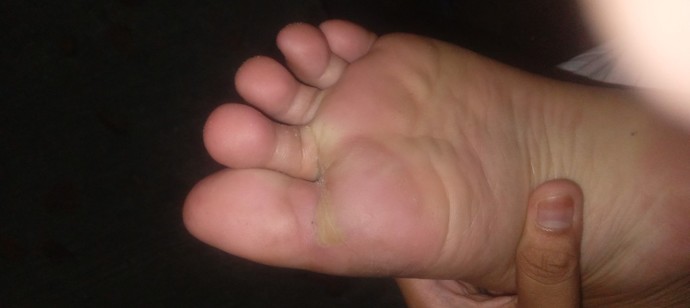 I have blister on my foot what should I do to get rid of it?