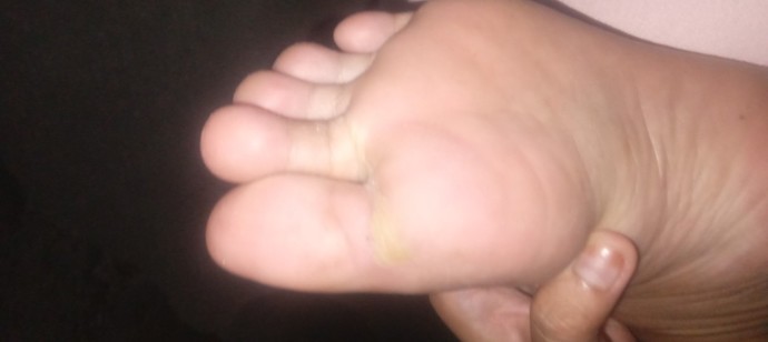 I have blister on my foot what should I do to get rid of it?