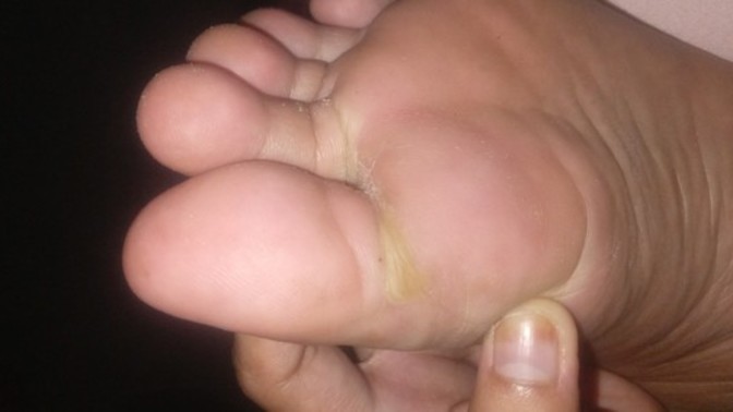 I have blister on my foot what should I do to get rid of it?
