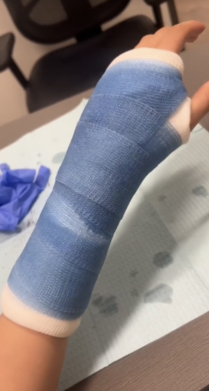 Have you ever broken/fractured something on your body? If so, where?