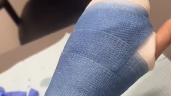 Have you ever broken/fractured something on your body? If so, where?