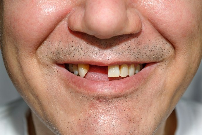 Have you ever dreamt that your teeth fell out?
