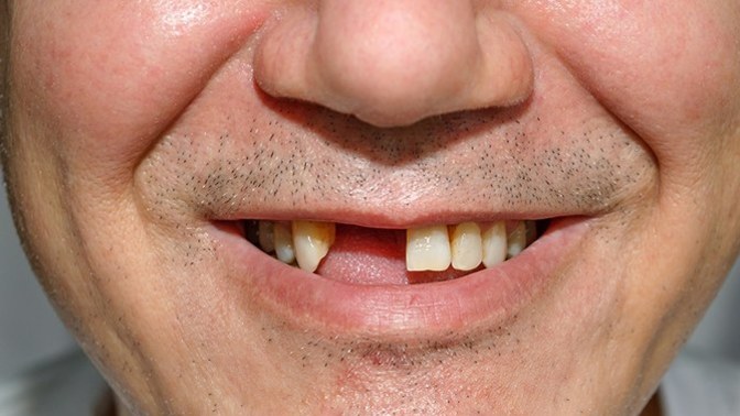 Have you ever dreamt that your teeth fell out?