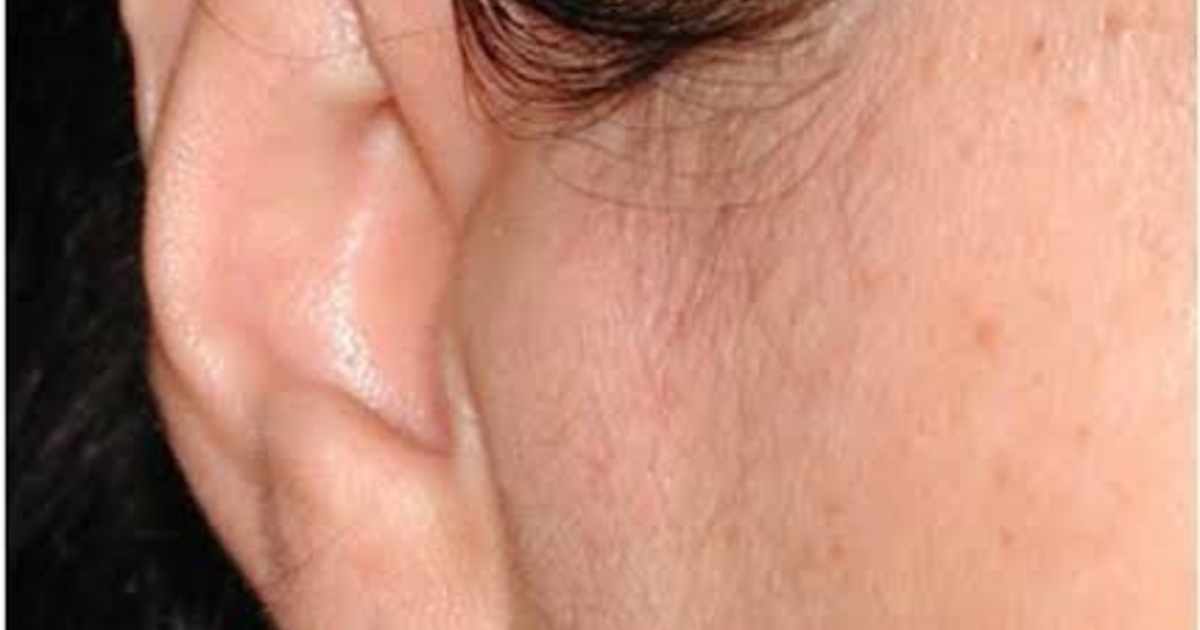 can-i-still-get-a-surgery-for-small-lump-in-my-ear-girlsaskguys