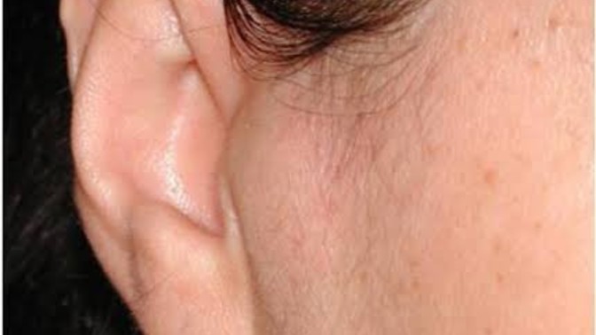 Can I still get a surgery for small lump in my ear?