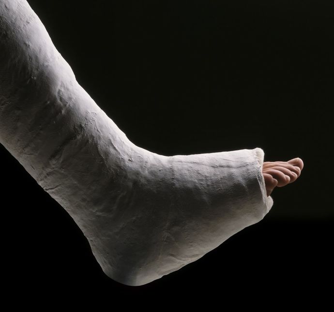 Have you ever broken a bone?