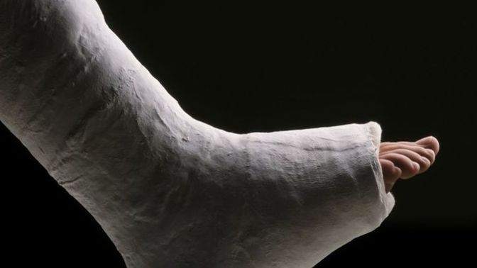 Have you ever broken a bone?