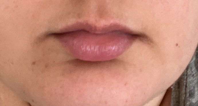 How to get rid of discolouration on the corners of my mouth?
