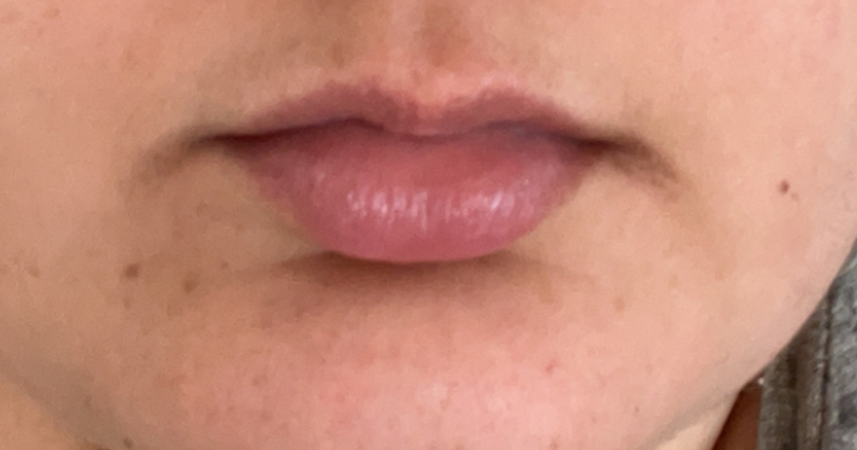 How to get rid of discolouration on the corners of my mouth? GirlsAskGuys