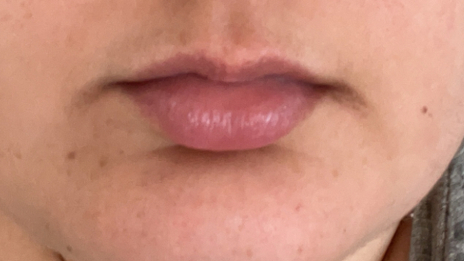 How to get rid of discolouration on the corners of my mouth?